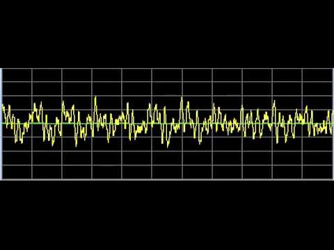 Chronic Fatigue Syndrome - Rife Frequencies