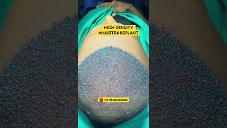 Hair Loss Treatment #hair #hairloss #hairlosstreatment #ytshorts #alopecia #hairtransplant #hairfall