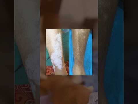 Best Vitiligo Treatments and Incredible Results at Skinaa Clinic #viral #shortsviral