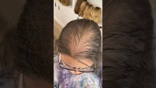 The Most REALISTIC Hair Topper For Hair Thinning ✨ Watch This!