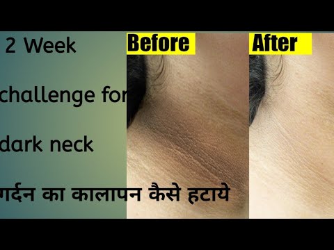 black neck remove coffee powder|gardan ka kalapan | काली गर्दन को साफ करने के घरेलू उपाय||