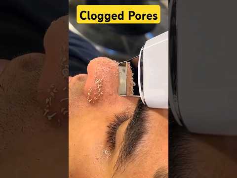 Get Rid of Clogged Pores Now! #pores #skincare #shorts #dadumedicalcentre