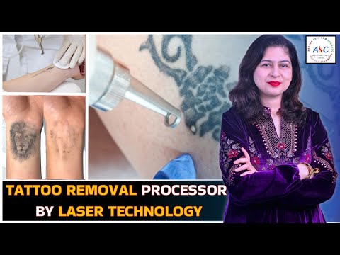 Laser Tattoo Removal in Jammu | Dr. Cheena Langer – Aastha Skin & Dermato-Cosmetic Centre