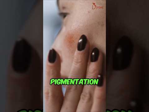 Say Goodbye to Pigmentation! Q-Switch Laser Treatment | Best Pigmentation Treatment