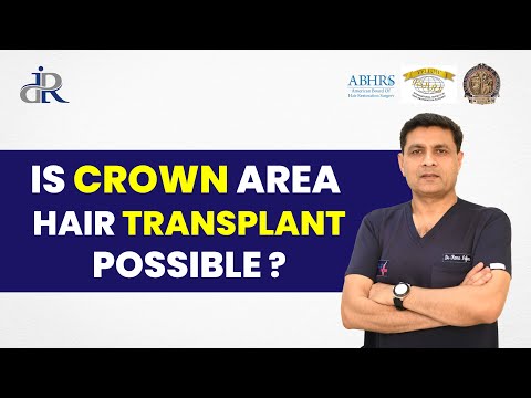 Crown Area Hair Transplant | Ultimate Guide to Crown Area Hair Transplant Surgery | Dr Rana Irfan