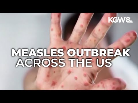 US measles cases already surpass last year's total