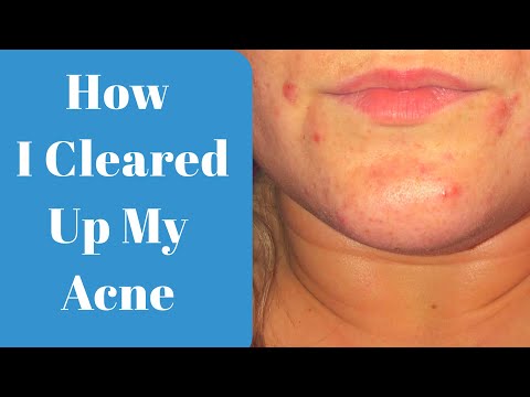 MY NIGHT TIME ROUTINE FOR ACNE PRONE SKIN