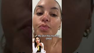 Hyperpigmentation treatment for skin of colour. #Hyperpigmentation