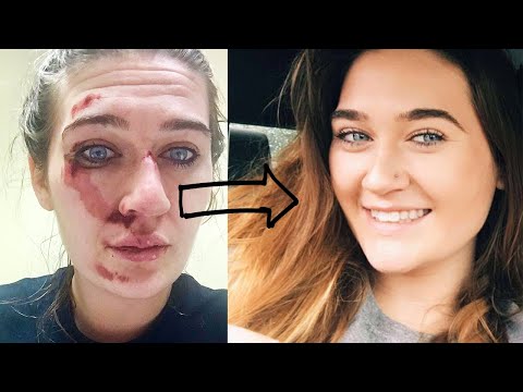 how to: COVER UP FACIAL SCARS WITH MAKEUP *woah*
