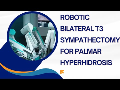 Robotic Bilateral T3 Sympathectomy for Palmar Hyperhidrosis: An Easy Minimally Invasive Solution