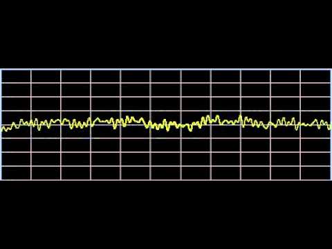 Torticollis - Rife Frequencies