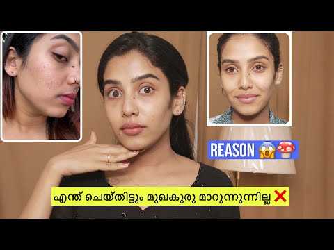 ഇത് വലിയ കഷ്ടം തന്നെ ❌ നിങ്ങളുടെ മുഖം Clear ആകും 💯💯 #glamyganga #clearskin