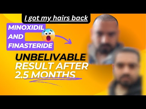 I got my hairs back - Minoxidil and finasteride results after 2.5 Months #minoxidilresult