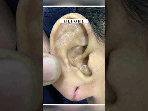 Best Earlobe Repair Treatment at Skinaa Clinic | #Viral #shortsviral