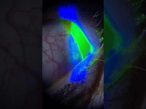 Removing a Torn Contact Lens