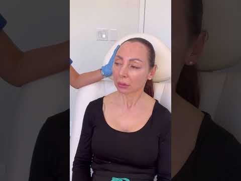 Cheek augmentation using filler injection. #cosmeticprocedure #cheekfiller #avebelle