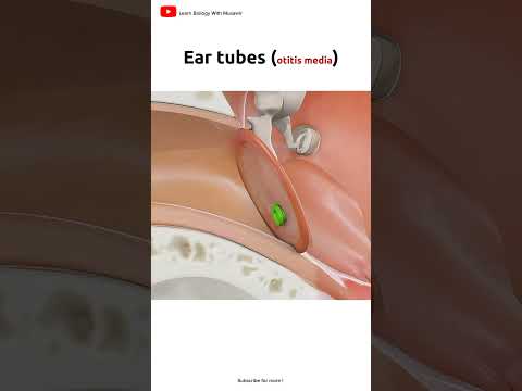 Otitis media and Ear tubes | 3D animation