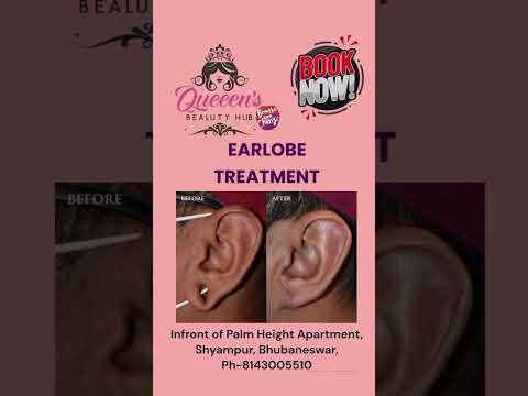 #Earlobe-treatment#Earlobe