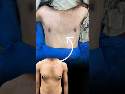 Get a Sculpted Chest with 360° 4Dx! Gynecomastia On Table Result #shortsfeed