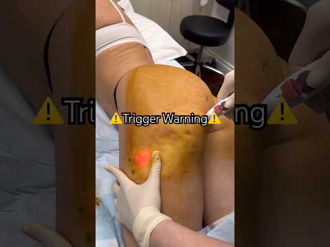 What’s causing cellulite? ⚠️TW⚠️ We’ll show you proof! #trending #trendingvideo #viral #beauty