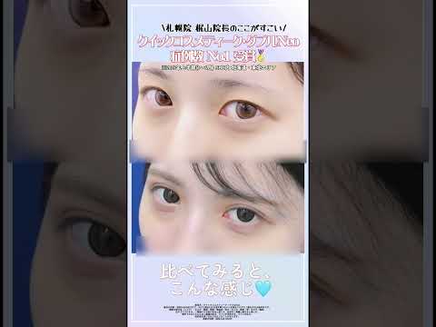 夏休み、お盆休みのご予約大好評受付中💜 #湘南美容クリニック#湘南美容クリニック札幌院  #クイックコスメティークダブルNeo #二重埋没法