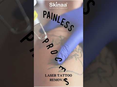 Best Laser Tattoo Removal Treatment at Skinaa Clinic #Viral #viralshorts