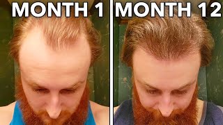 How I Reversed My Receding Hair Line In 12 Months