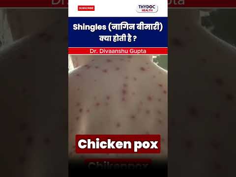 Shingles नागिन बीमारी क्या होती है | #shingles #doctor #shorts  @ThyDocHealth​