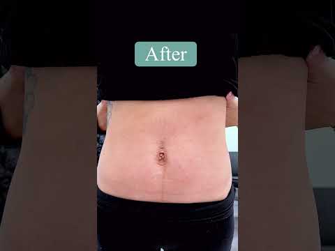 #fatdissolve #kybella #belkyra #skincare