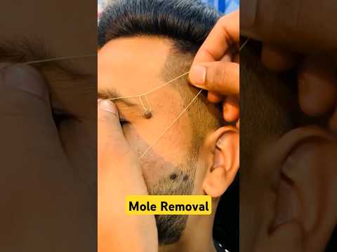 How to remove a mole? #moles #moleremoval #shorts #drniveditadadu