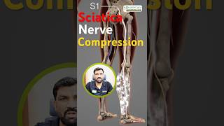 what is the sciatica nerve compression? 🙁🙁🙁 by Physiotherapist Dr. Arvind Jaga #sciatica