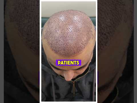 Recovery from Hair Transplant ?#drranairfan #hairfall #hairtransplant #hairloss #shorts