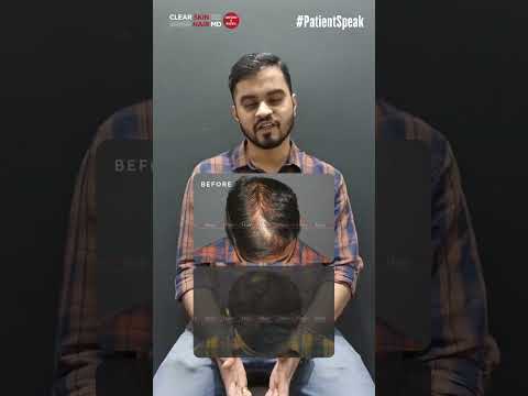 Stop Hair Loss in Its Tracks with PRP Therapy – See the Difference! | Testimonial | HairMD, Pune