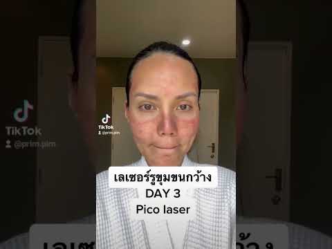 pico laser DAY3 #skincare #makeup #แต่งหน้า