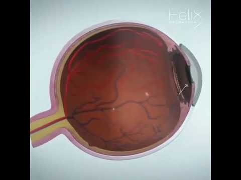 NEET CONCEPT 001#eyes #eyesight #neet2023 #aiimsdelhi #neetshorts #neetstudents