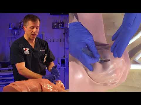 Emergency Bougie Cricothyrotomy Procedure Explained