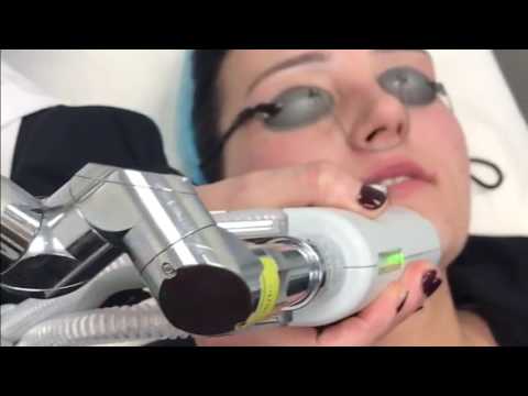 Halo Laser Treatment at Compass Dermatology