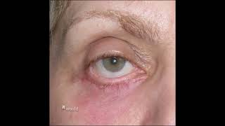 Understanding Eyelid Surgery #antiwrinkles #antiagesurgery #blepharoplasty #eyelidsurgery