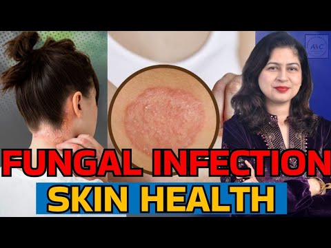 FUNGAL INFECTION & SKIN HEALTH | MONSOON SKIN CARE - DR CHEENA LANGER (SKIN SPECIALIST)
