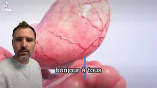 sleeve endoscopique, endosleeve - Dr Thibaut COSTE