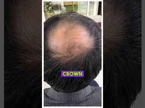 Crown Area Hair Transplant ?#drranairfan #hairfall #crownarea #hairtransplant #hairloss #fyp #shorts