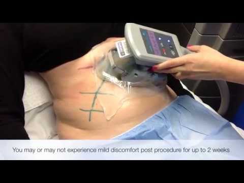 How CoolSculpting Works Rancho Cucamonga, CA