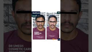 #medifacial #detanfacial #detanning #skinwhitening #skincare #skincareroutine #skincarereview #face