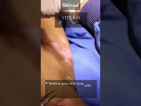 Effective Vitiligo Treatment | Say Goodbye to White Patches with Skinaa Clinic  #viral