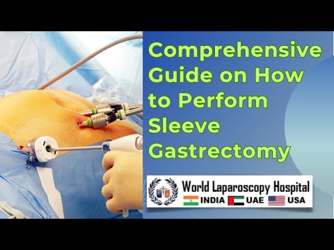 Comprehensive Guide on How to Perform Sleeve Gastrectomy