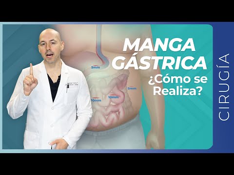 Manga Gástrica ¡La CIRUGÍA MÁS UTILIZADA en el MUNDO para Bajar de Peso!