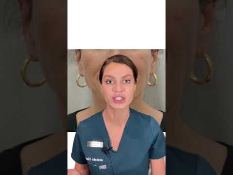 #sculptra #torontosculptra #avebelle #torontoblogger #cosmeticinjectables