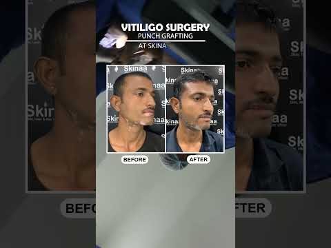 Vitiligo Treatment at Skinaa Clinic | Amazing Results #Viral #vitiligotreatment