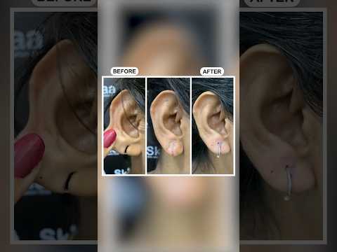 Earlobe Treatment at Skinaa Clinic with our Expert Team #earloberepair #youtubeshorts