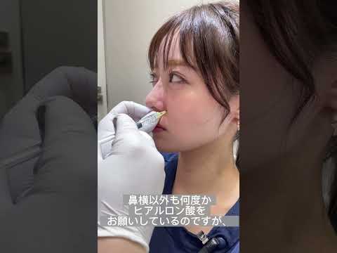 ほうれい線が薄くなって、中顔面も短く見えて大満足です🥰#美容 #美容皮膚科 #整形 #美容整形